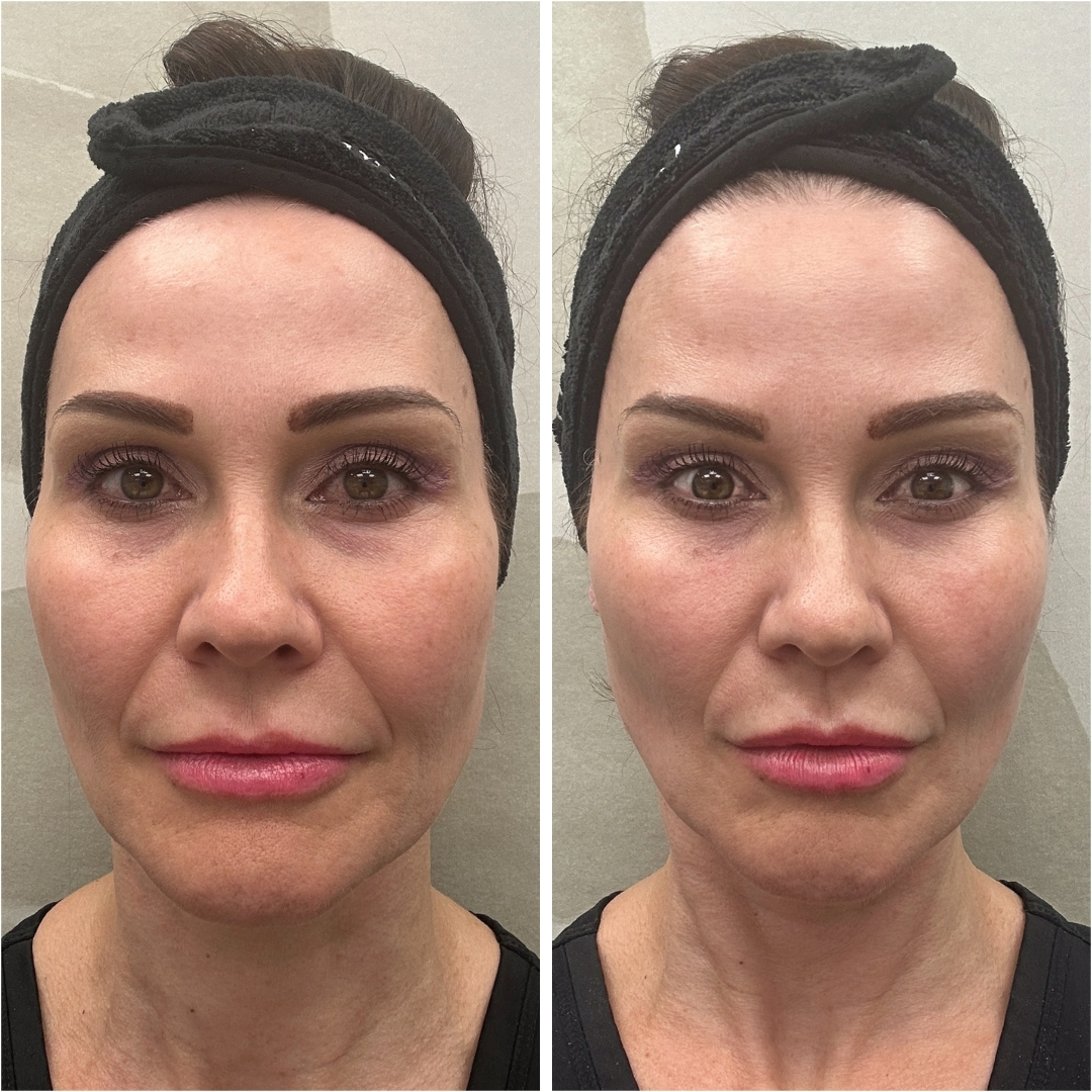 XERF before and after result
