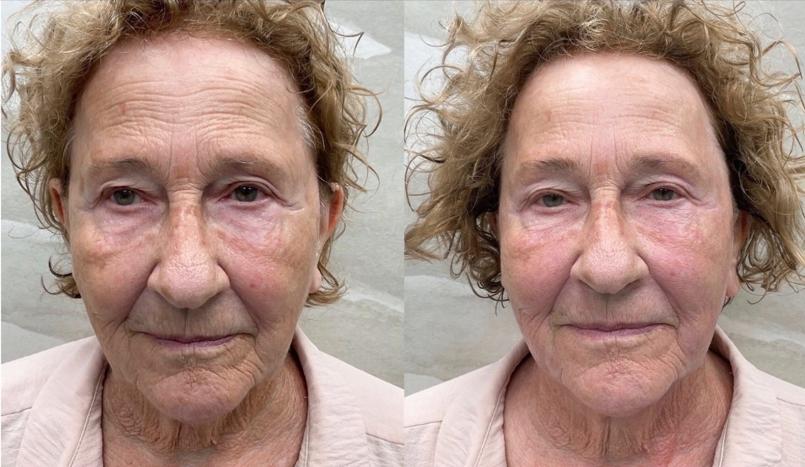 XERF before and after result